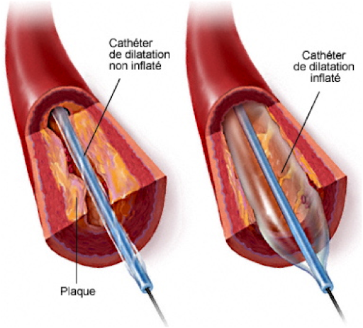 Angioplastie Coronaire